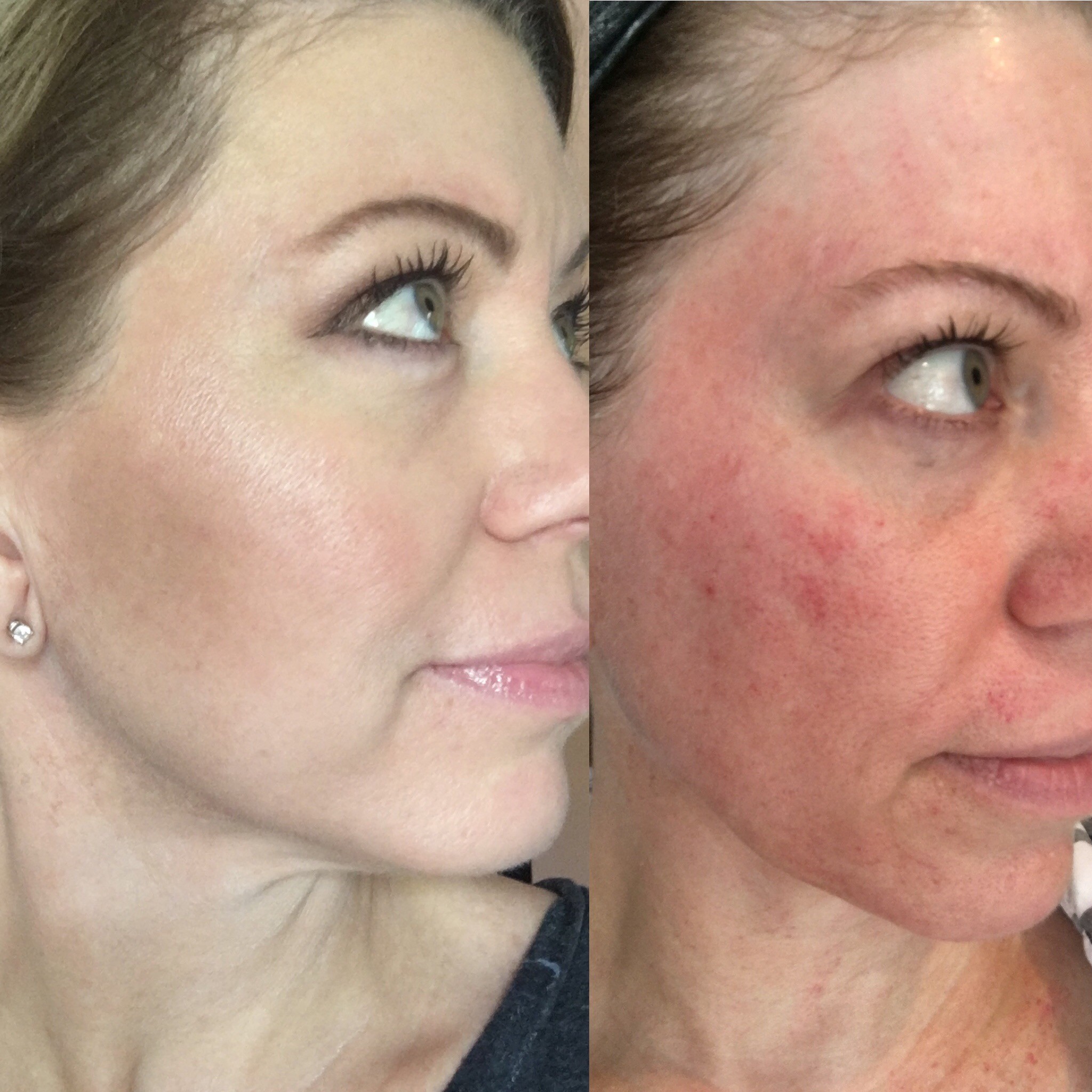 Microneedling — Avant